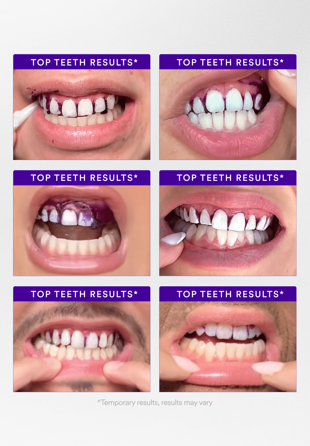 Ultimate Teeth Whitening Kit