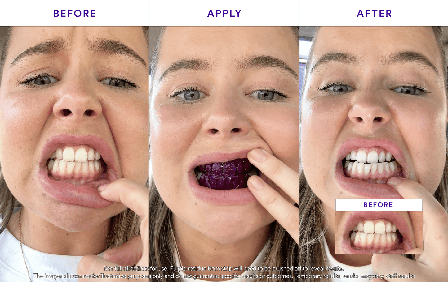 Ultimate Teeth Whitening Kit
